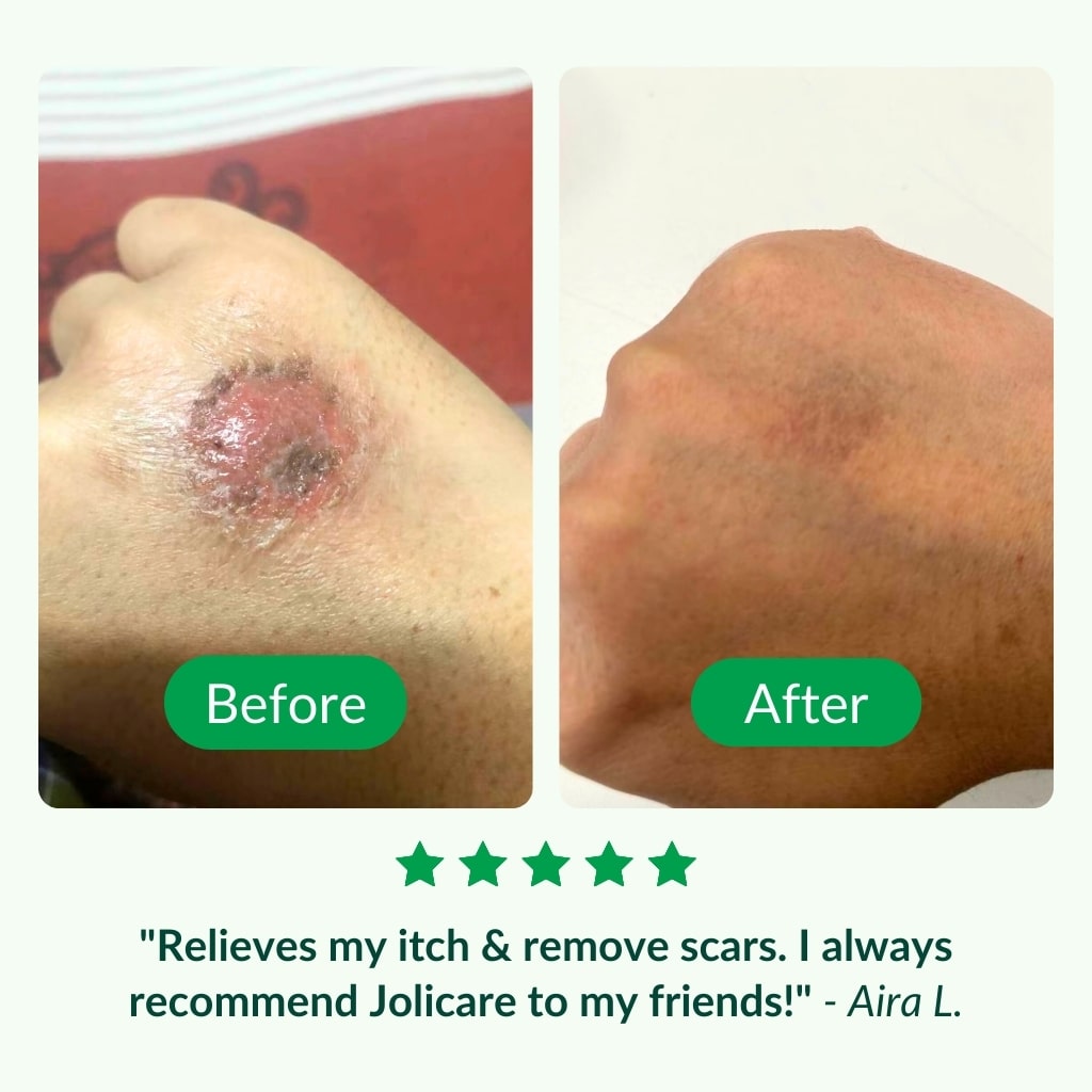 Jolicare Treatment Set